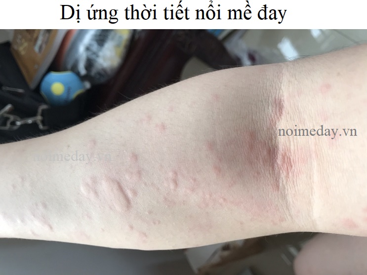 Dị ứng thời tiết nổi mề đay